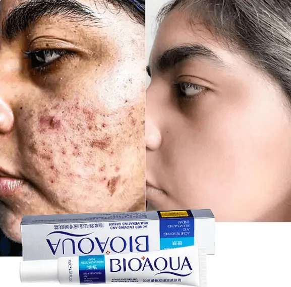 Bioaqua Acne Removing & Rejuvenating Cream - 30g